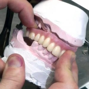Instant Denture Setups - Adapt to Model