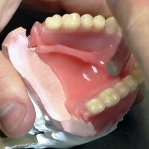 Instant Denture Setups - Rebase