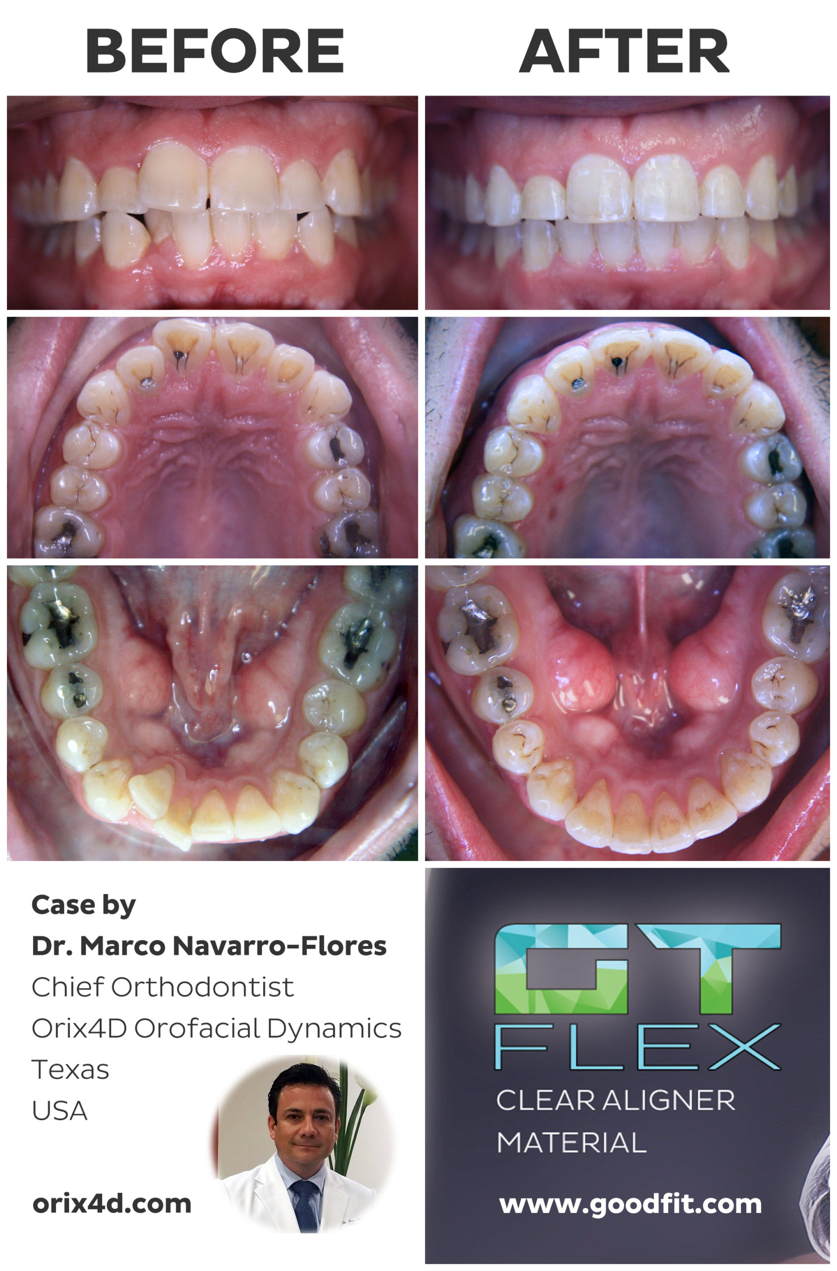 GT FLEX Clear Aligner Materials - Sample Case