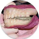 Denture Trays - Centric Relation (Take a Bite)