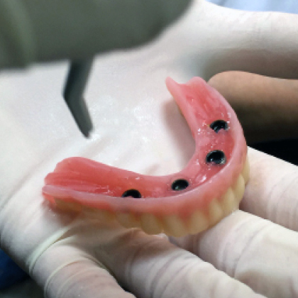Instant Overdentures - Pick up Attachments